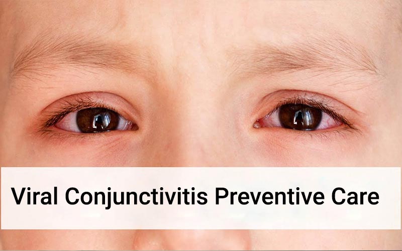Viral-Conjunctivitis-Preventive-Care