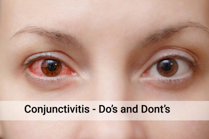 Conjunctivitis