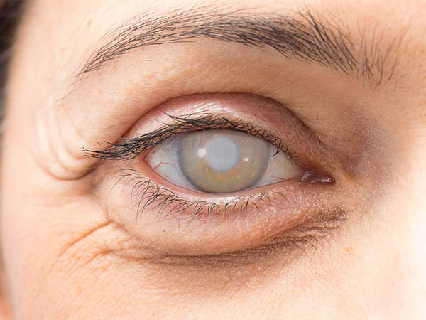 best cataract surgery in noida