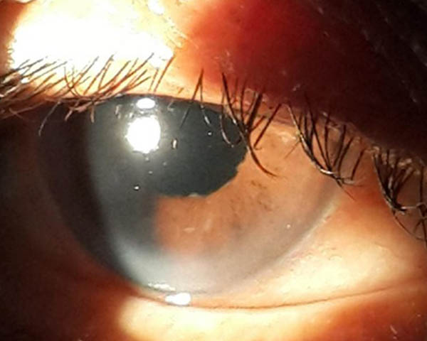 cataract eye surgery in noida