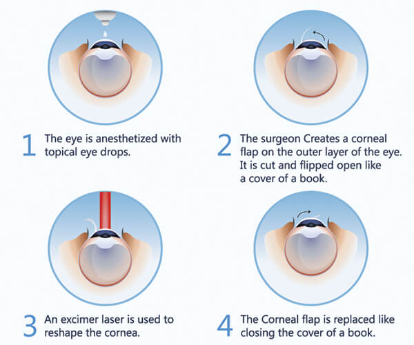 best lasik doctor in noida(1)