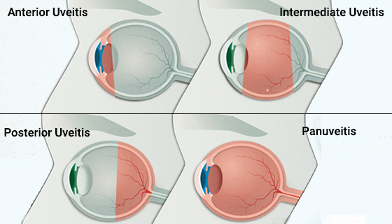 Kinds-Of-Uveitis
