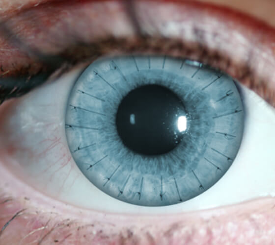 Specialized-Treatment- Cornea transplant surgery