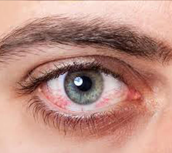 Specialized-Treatment--Dry Eye
