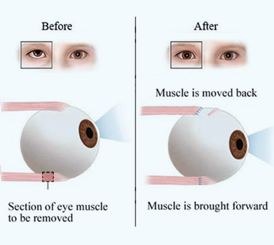 Squint-Treatment-Option