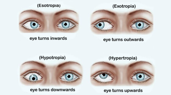 Types-Of-Squint