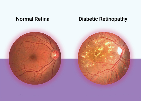 What Happens In Diabetic Retinopathy