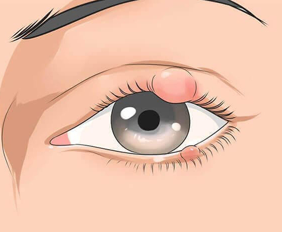 What-Happens-In-OCULOPLASTY