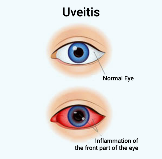 What-Happens-In-UVEITIS