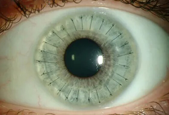 What is Corneal Transplant Surgery What is Corneal Transplant Surgery