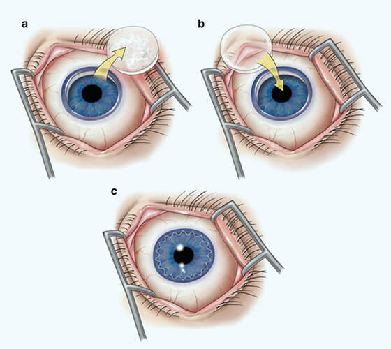 What is Corneal Transplantation What is Corneal Transplantation